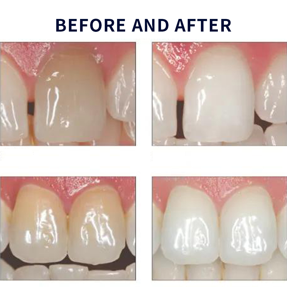 Отбеливающий набор opalution 2 – обзор и цена Teeth Whitening Paste
