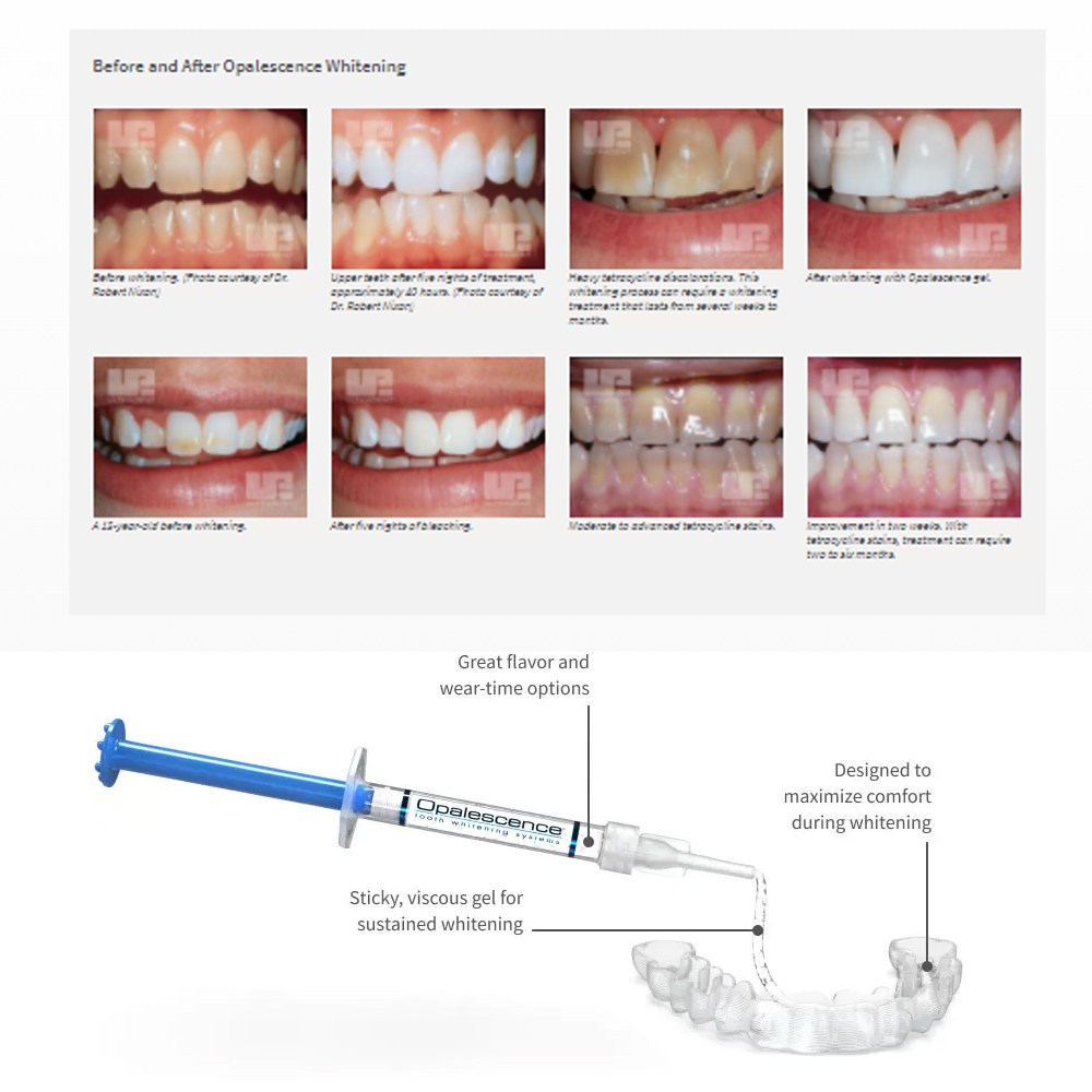 Отбеливающий набор opalution 2 – обзор и цена Teeth Whitening Paste