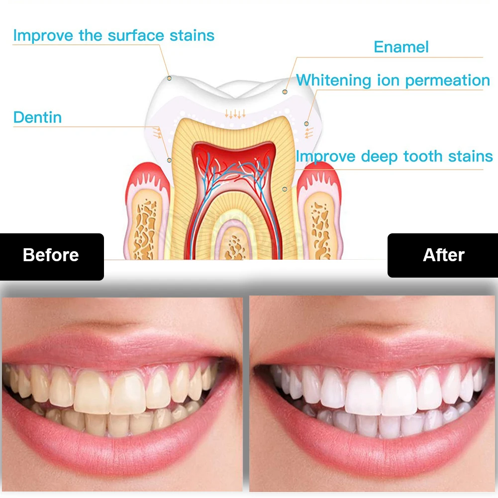 Набор для отбеливания зубов, м – обзор и цена Teeth Whitening Gels Used By Dentists