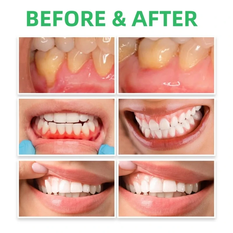 Капли для ремонта десен, снима – обзор и цена Teeth Whitening Paste